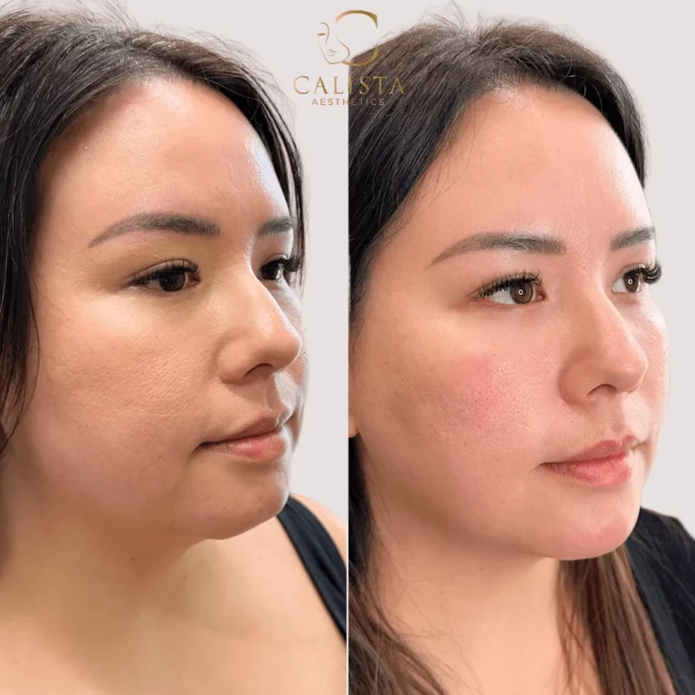 Side-by-side before and after images of a woman showing smoother skin texture and improved facial contour following a cosmetic skin treatment at Calista Aesthetics.