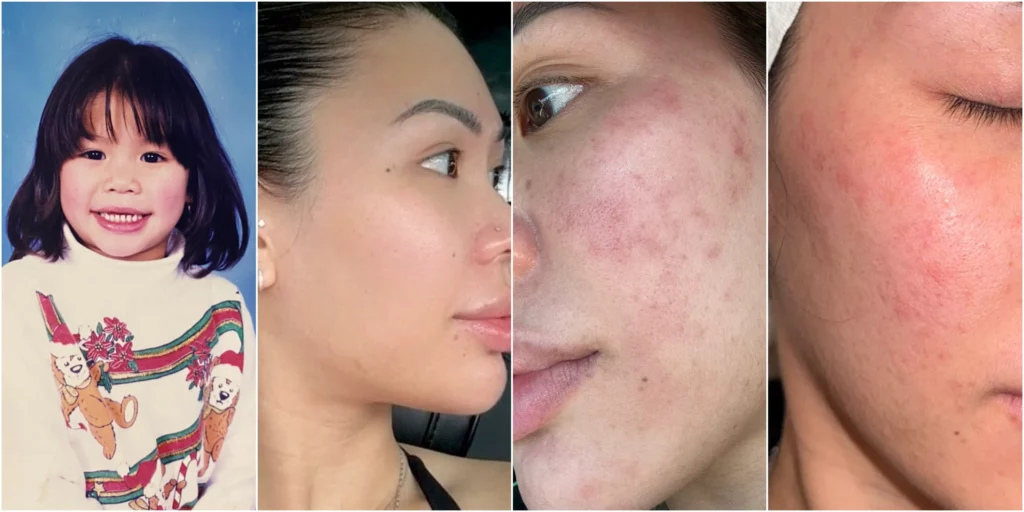 Childhood portrait of a smiling young girl with straight dark hair and bangs wearing a white sweater Side profile of an adult woman with clear smooth skin and minimal makeup Close-up of cheek with visible acne, redness, and textured skin Close-up of cheek with facial redness and irritation resembling rosacea or sensitive skin