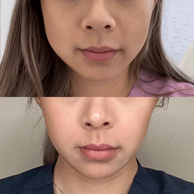 Top and bottom before-and-after photos of a woman’s lower face showing jawline slimming and reduced masseter fullness following Botox treatment