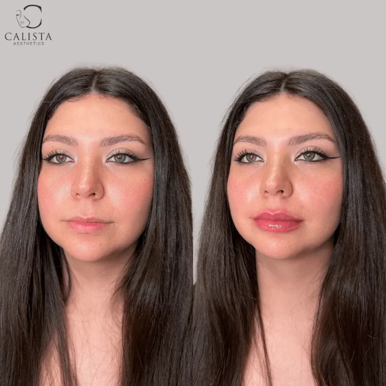 Side-by-side before and after images of a woman with long dark hair showing fuller, more defined lips following a lip filler treatment at Calista Aesthetics.