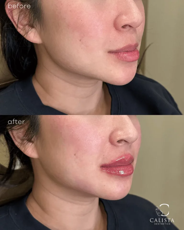 Side-angle before and after image of a woman with plumper, more contoured lips and natural definition achieved through filler at Calista Aesthetics.