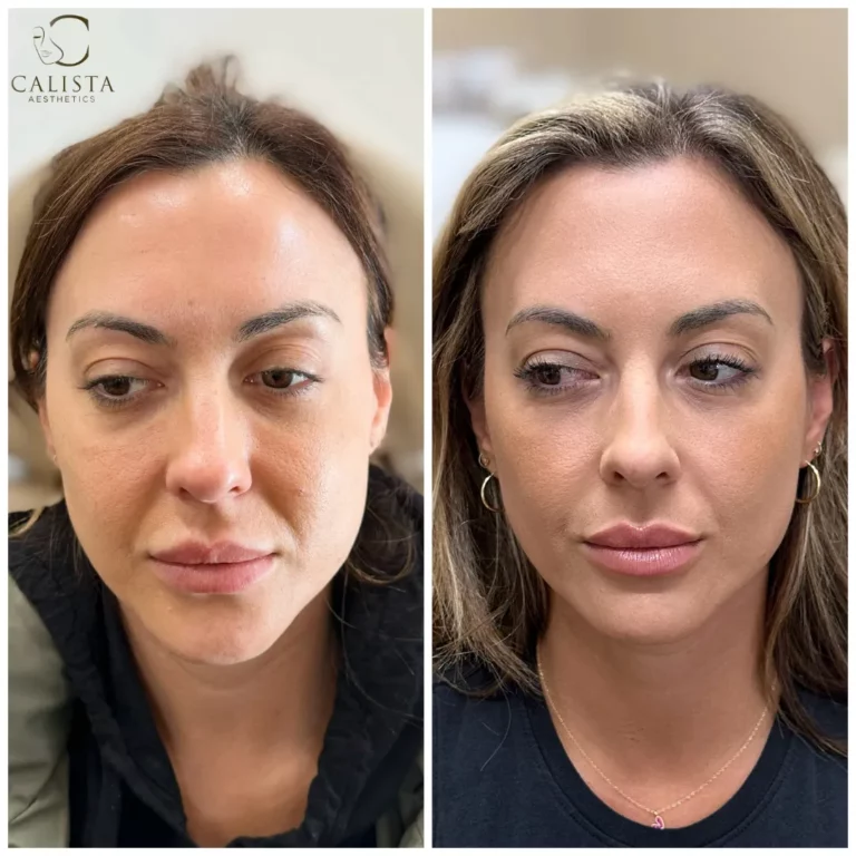 Before and after comparison of a woman showing smoother skin texture, reduced under-eye hollowness, and enhanced facial symmetry after aesthetic treatment at Calista Aesthetics.