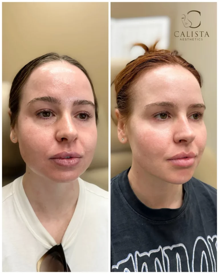 Before and after picture of woman with red hair in a clinical setting displaying results of facial rejuvenation treatments, including Sculptra for skin rejuvenation, PRF gel sessions, anti-wrinkle maintenance, masseter Botox for facial slimming, lip asymmetry correction, and chin filler, with treatment areas labeled.