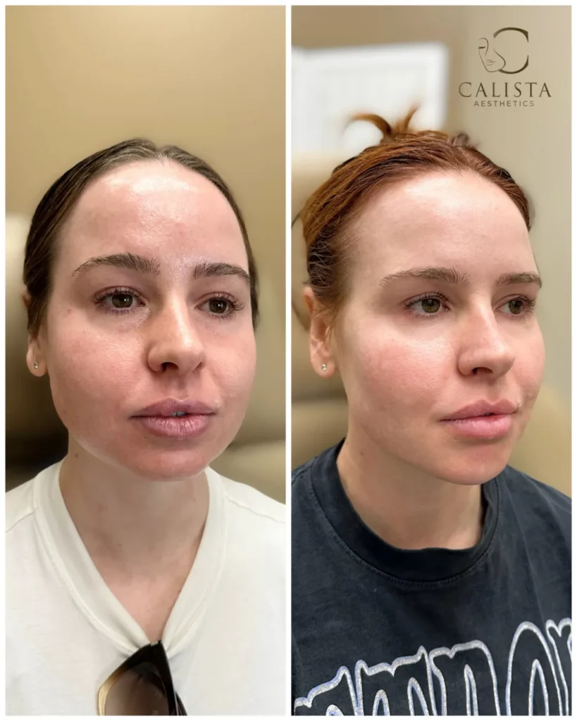 Before and after picture of woman with red hair in a clinical setting displaying results of facial rejuvenation treatments, including Sculptra for skin rejuvenation, PRF gel sessions, anti-wrinkle maintenance, masseter Botox for facial slimming, lip asymmetry correction, and chin filler, with treatment areas labeled.