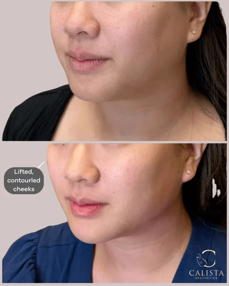 Before and after images of a woman showing enhanced facial definition with lifted, contoured cheeks following a cosmetic treatment at Calista Aesthetics.