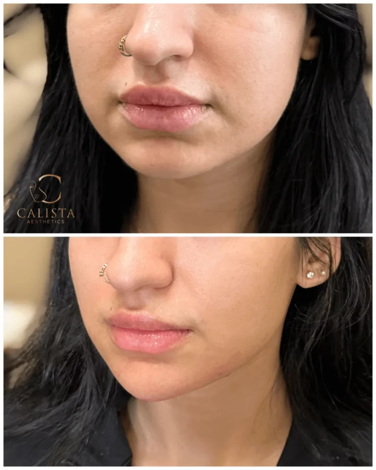 Before and after images of a woman showing smoother, more balanced lips with improved shape and definition following a cosmetic lip enhancement at Calista Aesthetics.