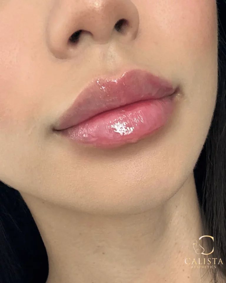 Close-up of a woman's lips after a lip filler treatment, showing enhanced volume and a glossy finish, with the Calista Aesthetics logo in the corner.
