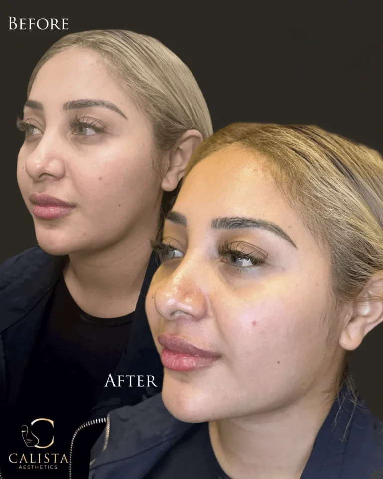 Before and after comparison showing enhanced lower face balance and a more defined jawline following aesthetic treatment at Calista Aesthetics.