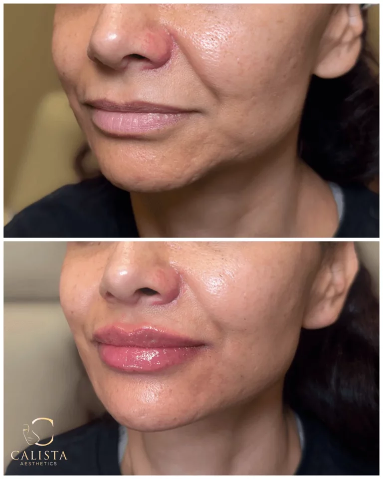 Before and after images of a woman showing enhanced lip volume and improved hydration with a smoother skin appearance following a cosmetic treatment at Calista Aesthetics.