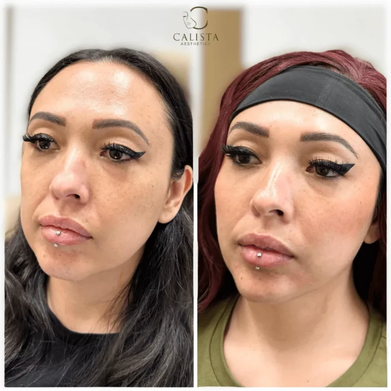 Side-by-side before and after images of a woman showing enhanced facial contour and fuller lips following aesthetic treatments at Calista Aesthetics.