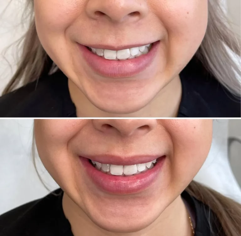 Close-up before and after image of a woman smiling, showing results of a cosmetic lip flip treatment with enhanced upper lip volume and definition.