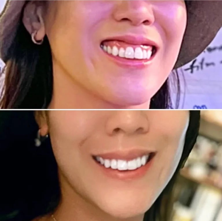 Before and after close-up image of a woman smiling, showing fuller upper lip and smoother lip contour following a cosmetic lip flip procedure.