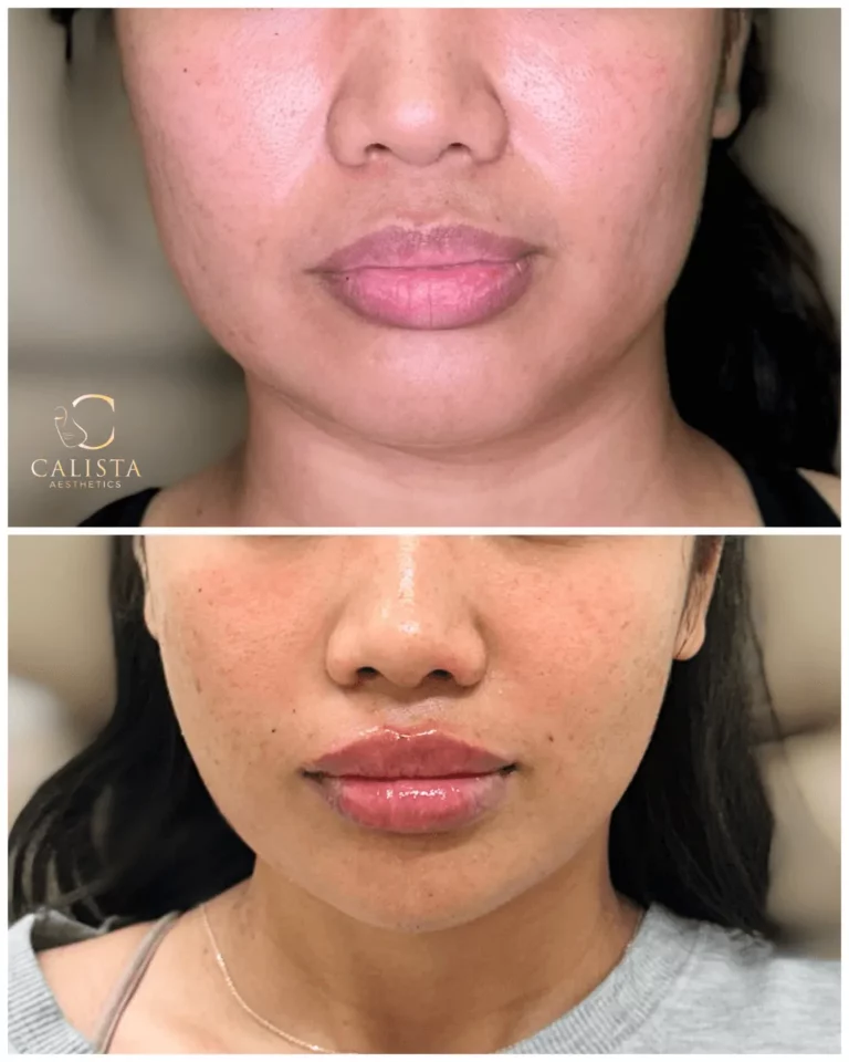 Close-up before and after photo of a woman’s lips displaying fuller shape, smoother texture, and improved symmetry after lip filler treatment at Calista Aesthetics.