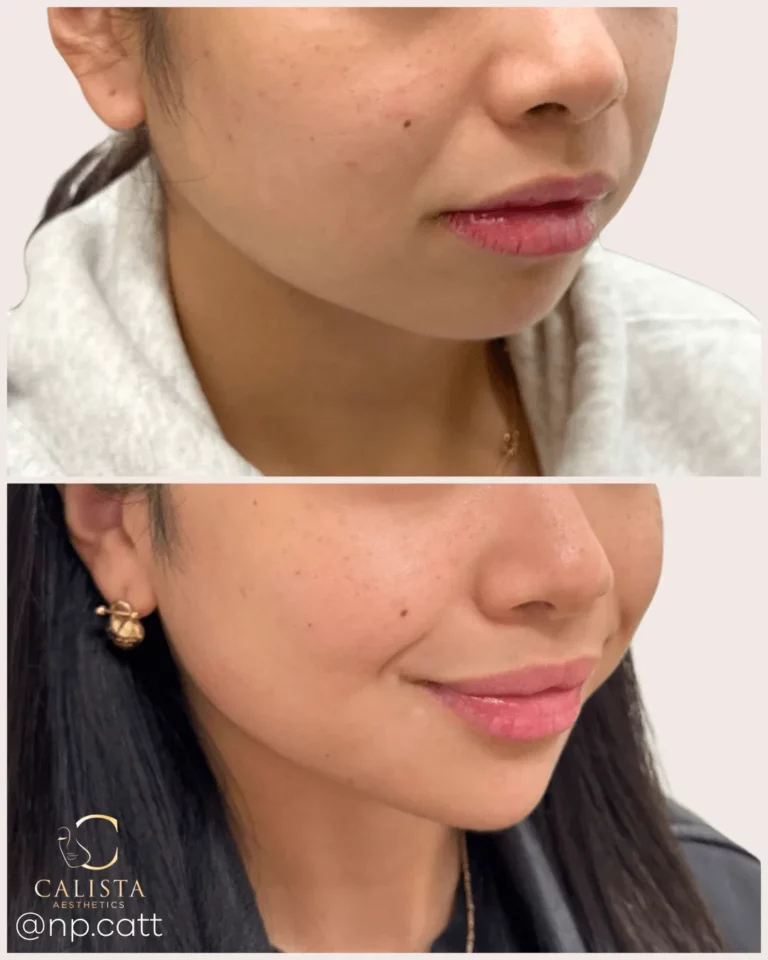 Before and after images of a woman showcasing smoother, more defined lips and enhanced symmetry following a cosmetic lip treatment at Calista Aesthetics.