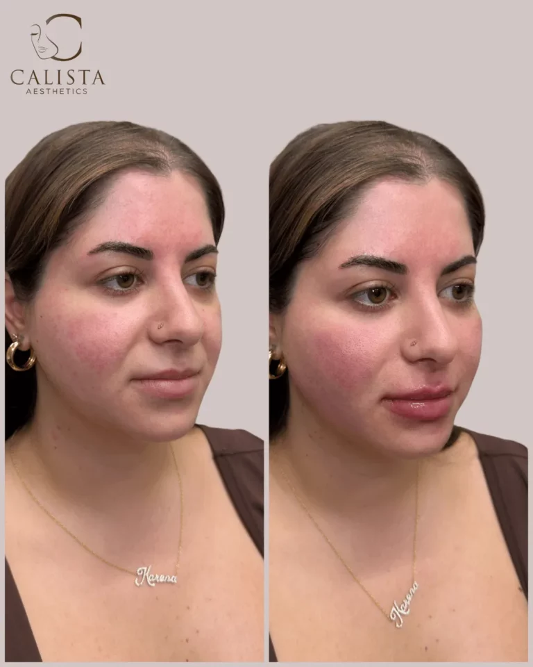 Side-by-side before and after images of a woman showing fuller, more defined lips and enhanced facial symmetry following a cosmetic treatment at Calista Aesthetics.