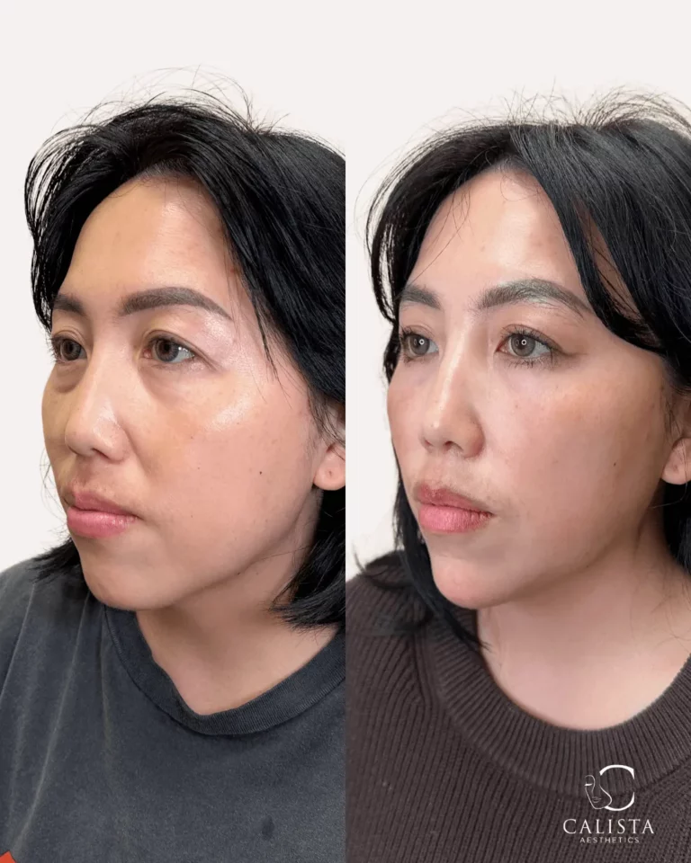 Before and after comparison of a woman showing enhanced cheek contour, defined jawline, and improved facial symmetry following aesthetic treatment at Calista Aesthetics.