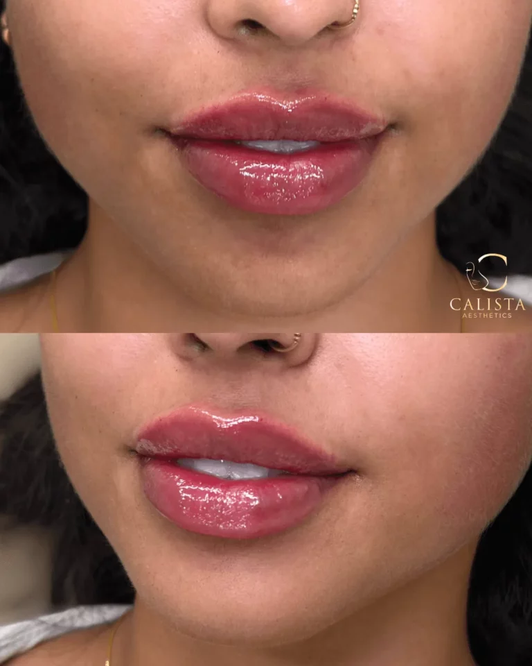 Close-up before and after images of a woman's lips showing enhanced volume and definition following a lip filler treatment at Calista Aesthetics.