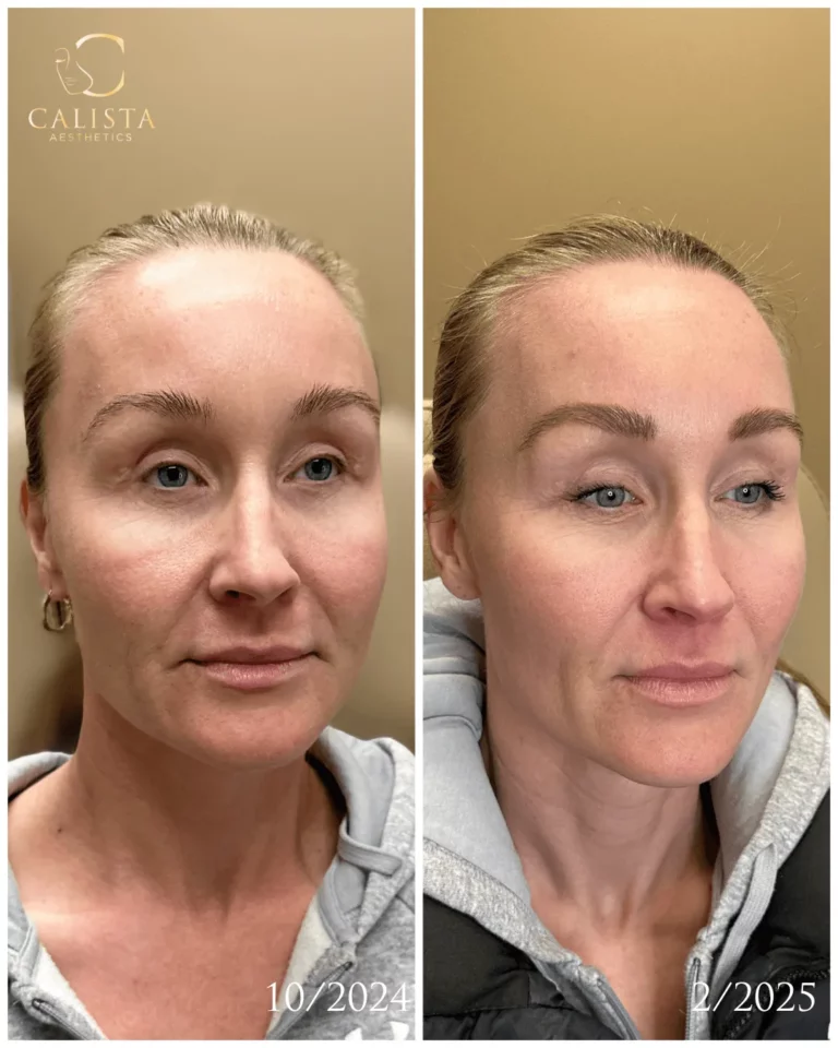 Side-by-side before and after images of a woman showing facial rejuvenation results over four months, with smoother skin and enhanced facial contours, branded with Calista Aesthetics.