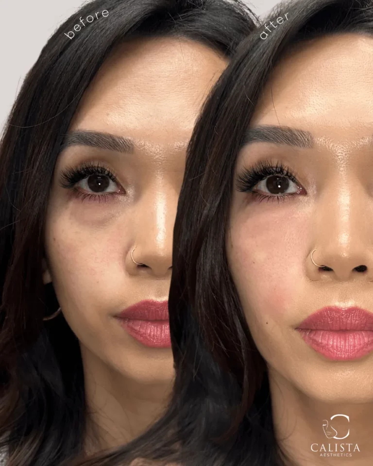 Before and after image showing under-eye filler treatment results on a woman, with reduced dark circles and smoother skin in the after photo, branded with Calista Aesthetics.