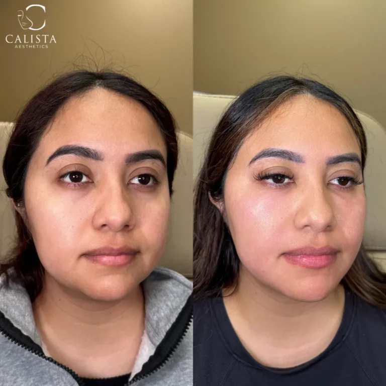 Before and after comparison of a woman with brighter, more lifted facial appearance and subtle enhancements to cheeks and lips after aesthetic procedure at Calista Aesthetics.