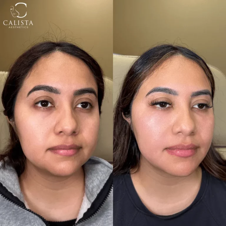 Before and after image of a woman showing facial enhancement results, with brighter under-eyes, fuller lips, and added eyelashes, branded with Calista Aesthetics.
