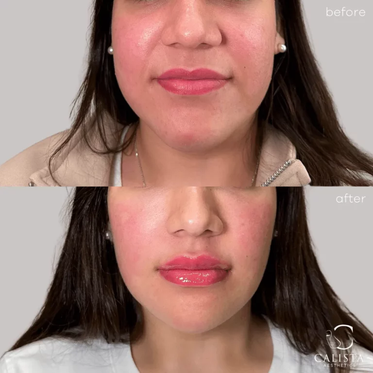 Before and after comparison of a woman's face showing results of a lip enhancement treatment, with fuller, glossier lips in the after image, branded with Calista Aesthetics.