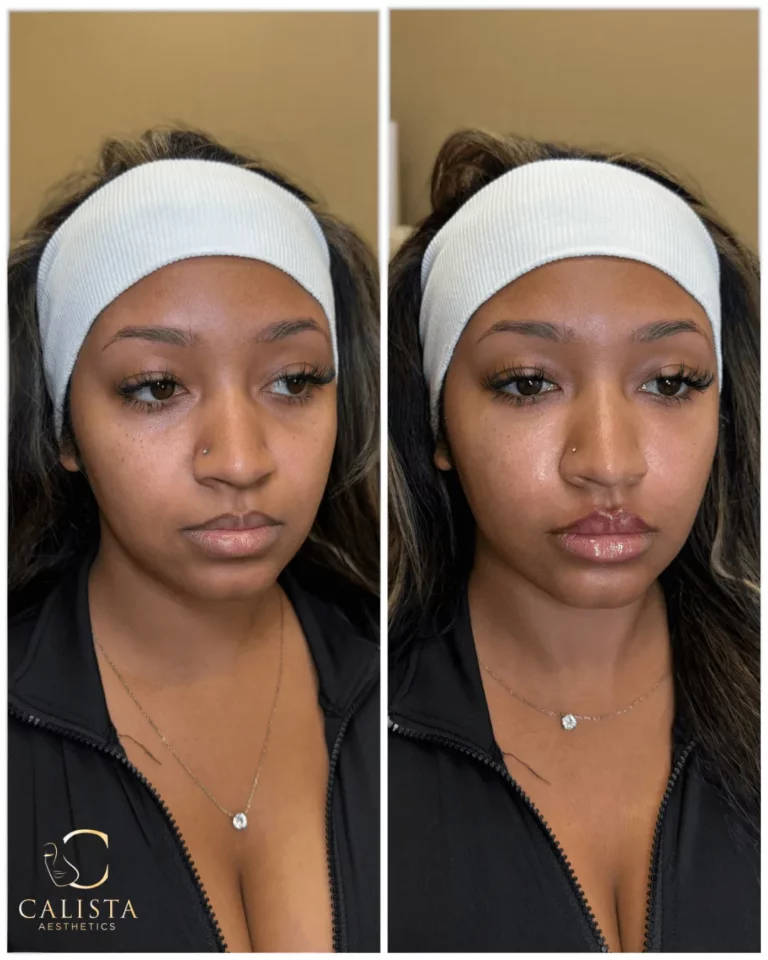 Before and after image of a woman showing lip enhancement results, with fuller, glossier lips and subtle facial rejuvenation, branded with Calista Aesthetics.