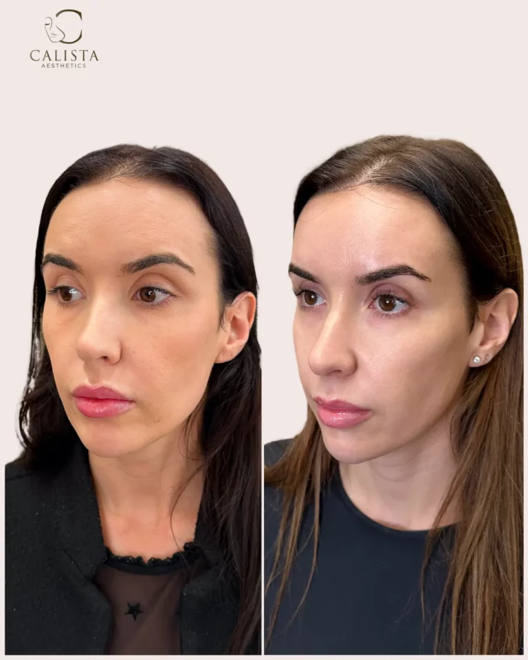 Before and after photo of a woman with improved cheek contour, smoother skin, and balanced facial features following cosmetic enhancement at Calista Aesthetics.