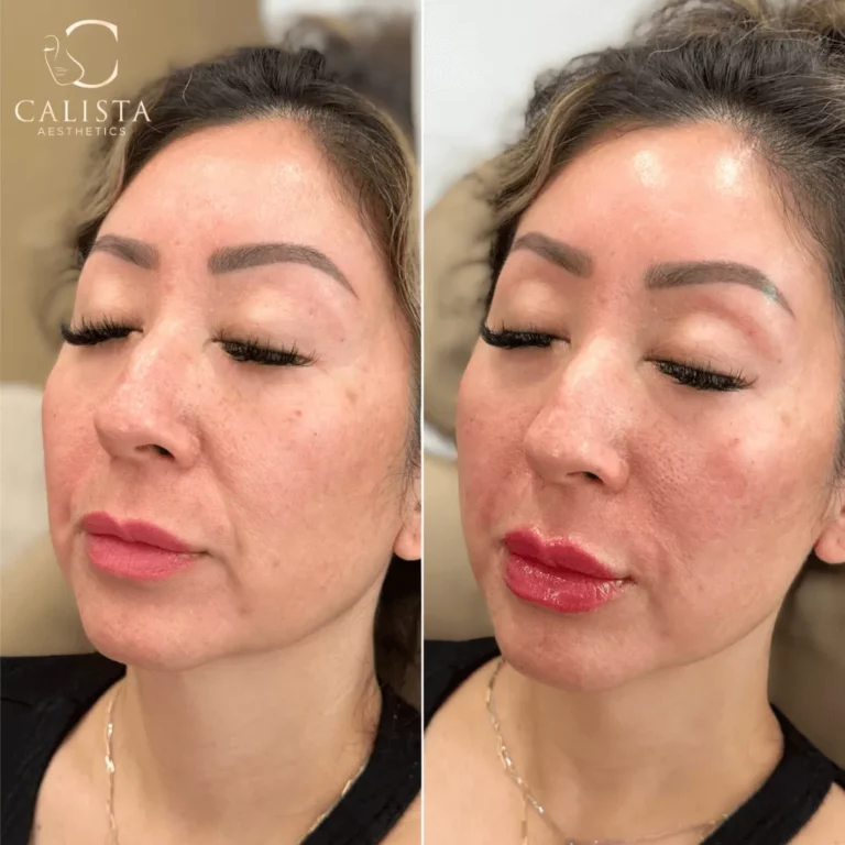 Side-by-side before and after images of a woman with eyes closed showing plumper, more defined lips and a refreshed facial appearance following a cosmetic treatment at Calista Aesthetics.