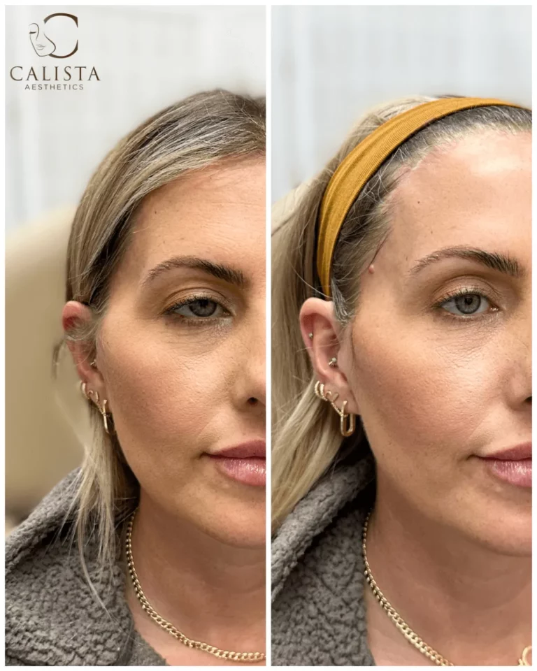 Close-up before and after image highlighting enhanced cheek volume, reduced fine lines, and a refreshed facial appearance after cosmetic procedure at Calista Aesthetics.