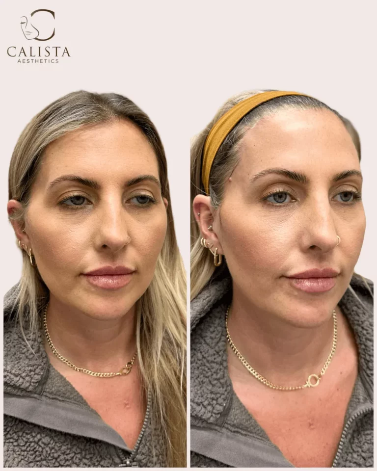 Before and after comparison of a woman showing lifted cheeks, smoother skin, and improved facial contour following aesthetic treatment at Calista Aesthetics.