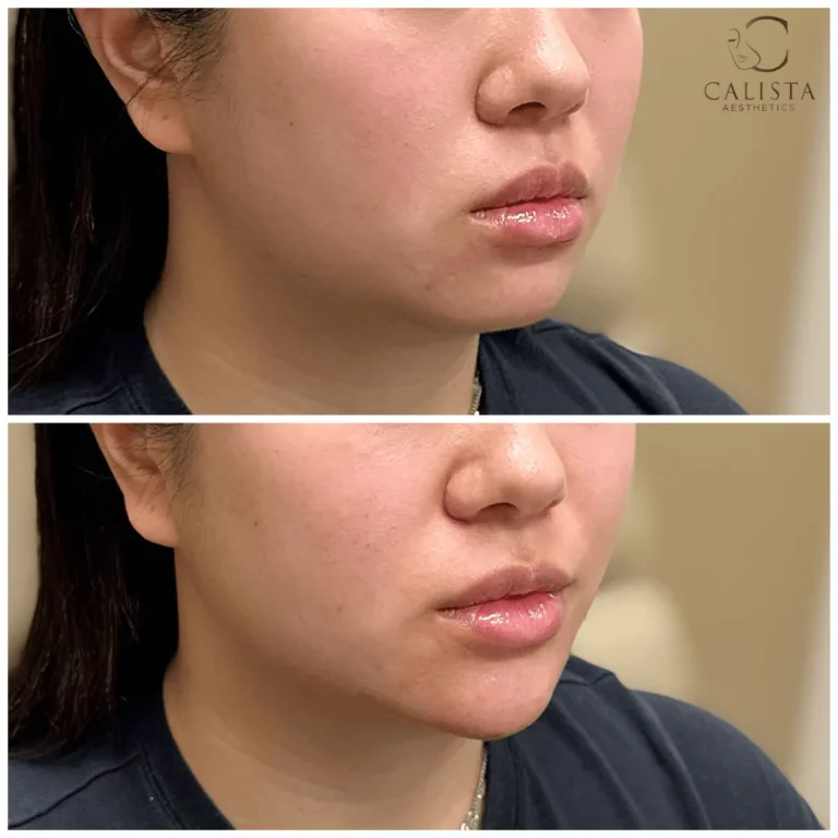 Before and after images of a woman showing enhanced lip volume and improved facial contour following a cosmetic treatment at Calista Aesthetics.